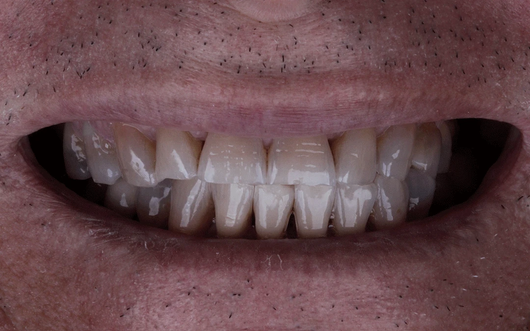 Sorriso antes do tratamento com lentes de contato dental
