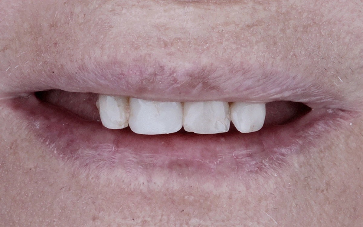 Sorriso antes da reabilitação estética