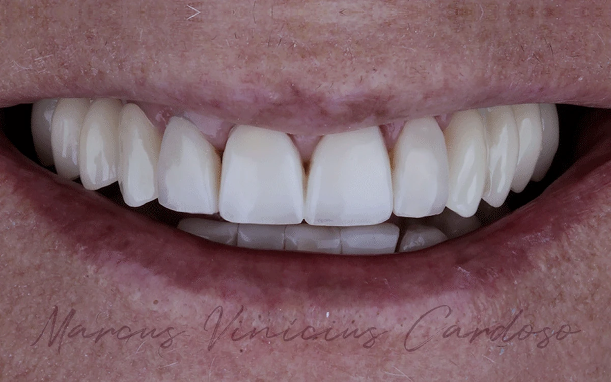 Sorriso depois da reabilitação estética